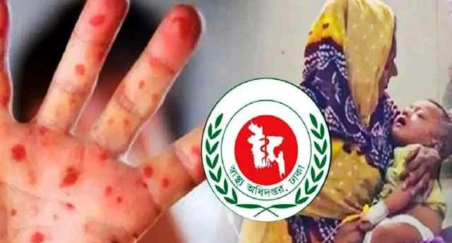 হাম উপসর্গে আরও ৩ শিশুর মৃত্যু